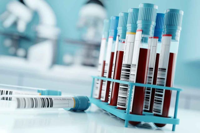 Rack of blood sample tubes