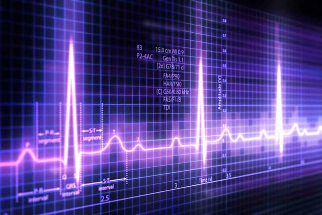 ECG trace